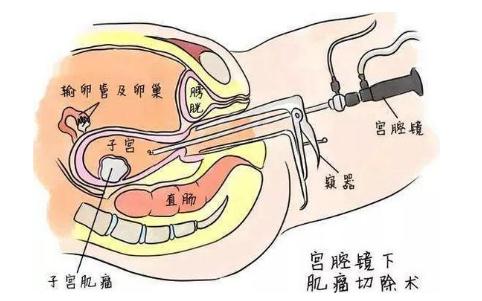 宫腔镜对于检查做试管的帮助多大宫腔镜注意事项